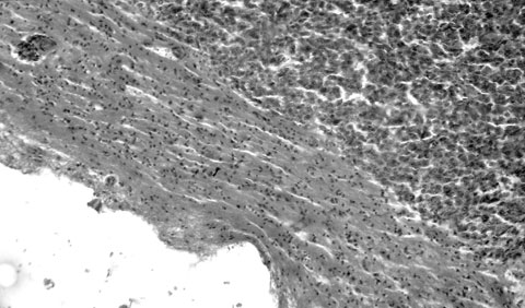 Субкортикальный церебральный метастаз плоскоклеточного неороговевающего рака легкого