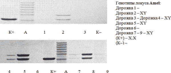 Электрофореграмма амплифицированных фрагментов ДНК локуса Амелогенина