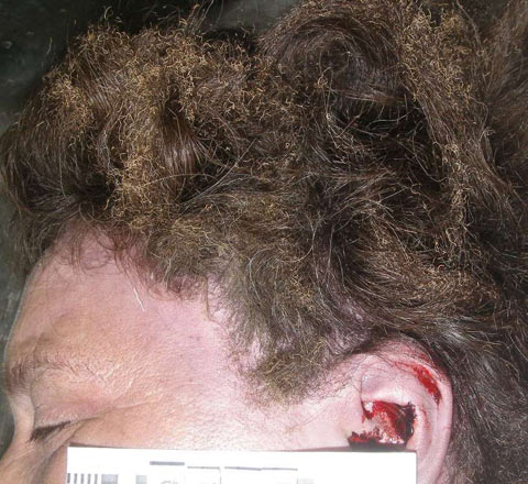 Опаление волос и жидкая кровь в наружном слуховом проходе