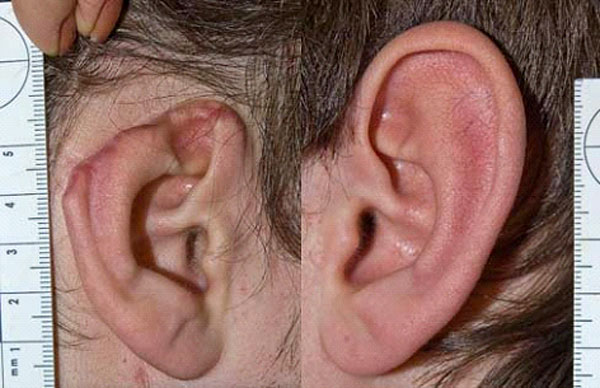 Дефект правой ушной раковины (для сравнения фото скомбинировано с неповрежденной левой ушной раковиной).