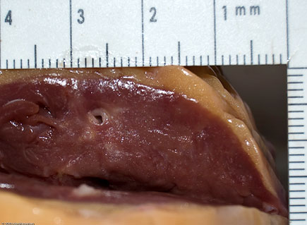 Погруженная в миокард часть передней межжелудочковой ветви левой венечной артерии.