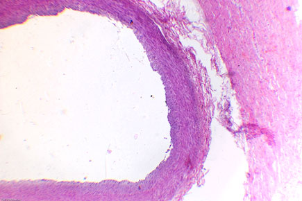 Поперечный срез погруженной в миокард части венечной артерии (справа виден «мостик».
