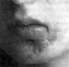 Келоидный рубец с деформацией нижней губы