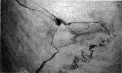Вдавленный перелом при ударе деревянным предметом цилиндрической формы в непрочностной участок черепа